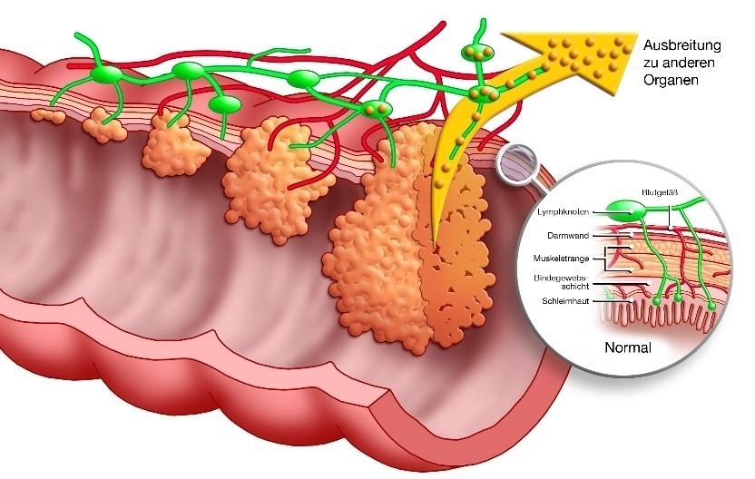 "Darmkrebs muss kein Todesurteil sein" / Service / IVZ