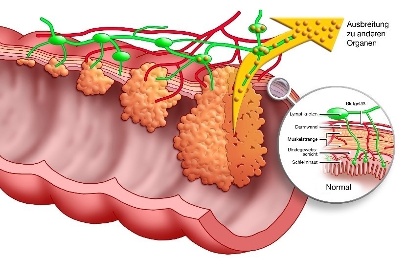&quot;Darmkrebs muss kein Todesurteil sein&quot; / Service / IVZ